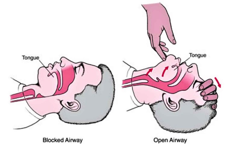 Techniques For Opening An Airway On An Unconscious Patient ...